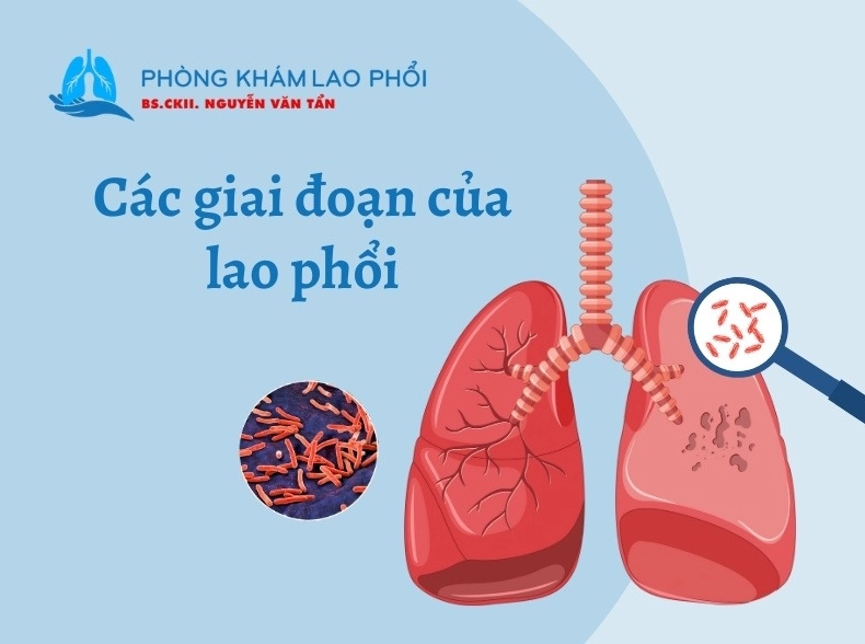 Các giai đoạn của lao phổi: Nguyên phát, tiềm ẩn và hoạt động