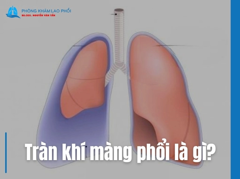 Tràn khí màng phổi là gì? Nguyên nhân, dấu hiệu và điều trị