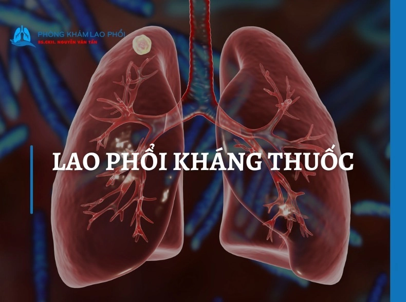 Lao phổi kháng thuốc: Dấu hiệu nhận biết và phương pháp điều trị 
