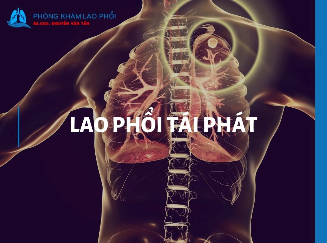 Lao phổi tái phát: Nguyên nhân, triệu chứng và cách điều trị