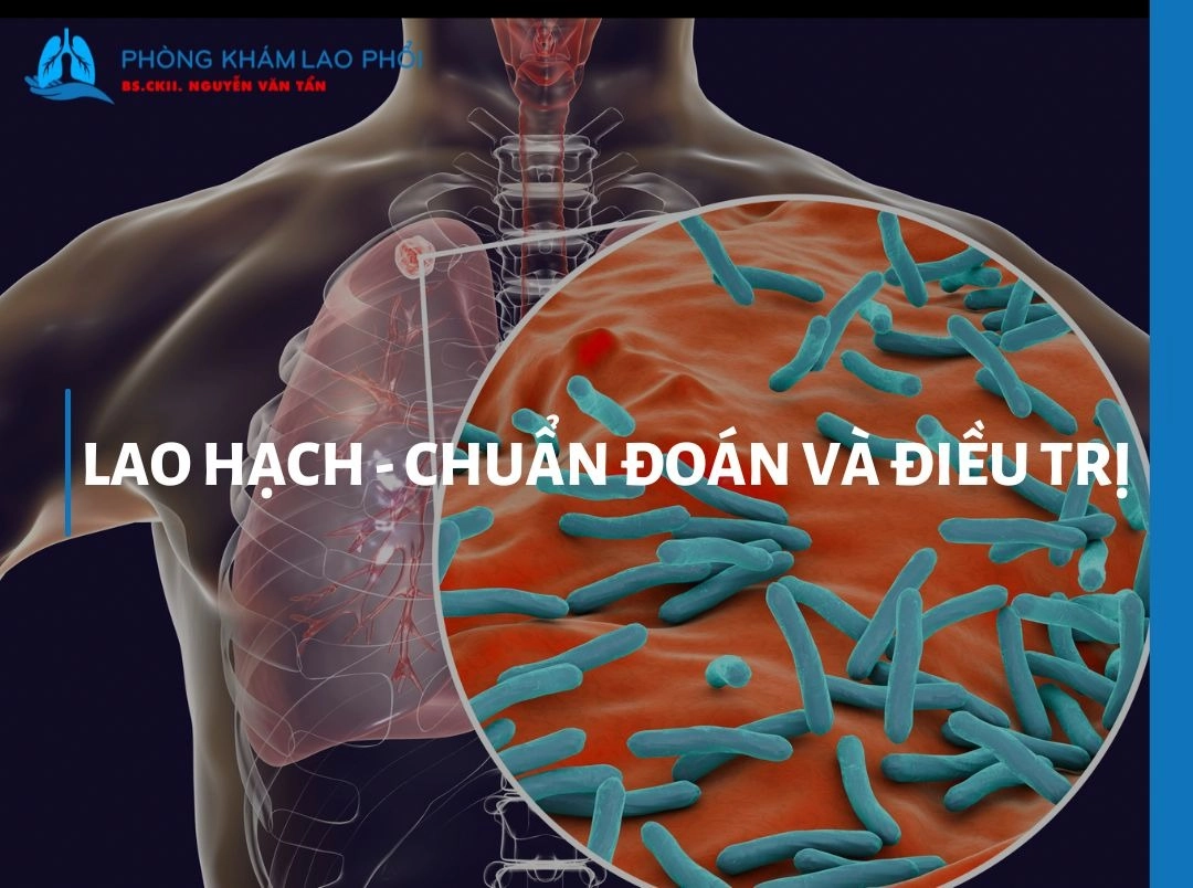 Lao hạch - chuẩn đoán và điều trị