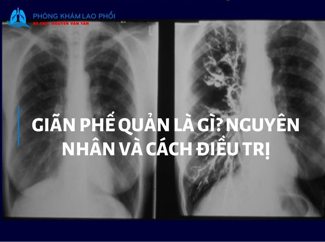 Giãn phế quản là gì? Nguyên nhân và cách điều trị