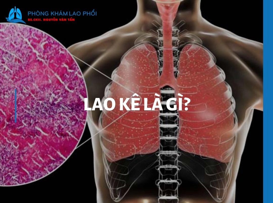 Lao kê là gì? Cách nhận biết sớm để điều trị kịp thời