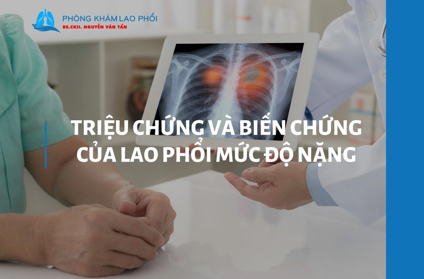 Lao phổi mức độ nặng: Triệu chứng và cách điều trị hiệu quả