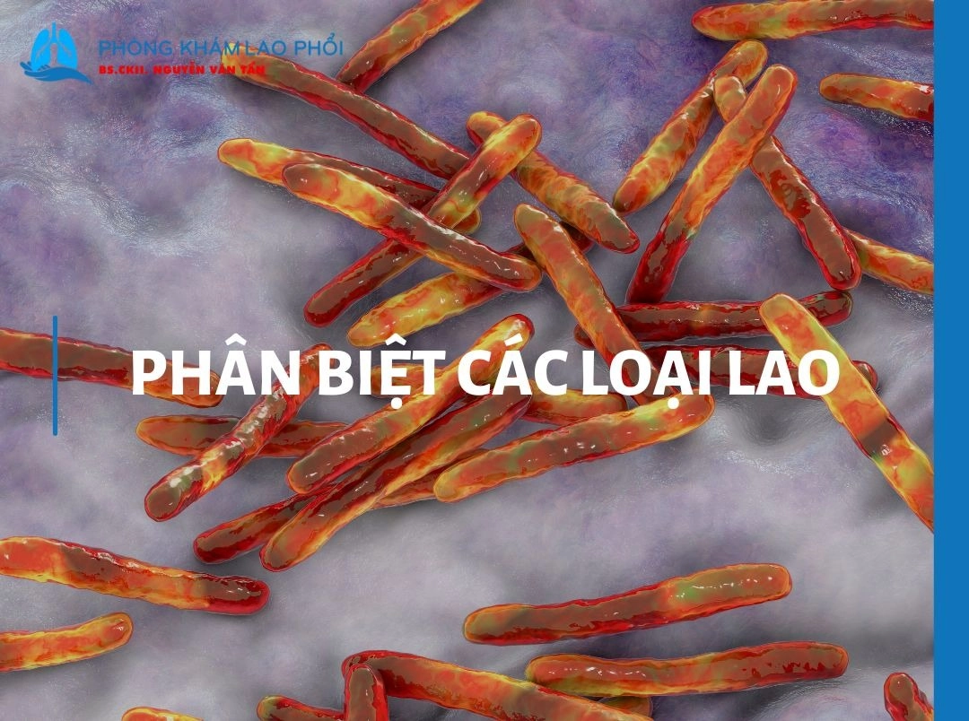 Phân biệt các loại bệnh lao và dấu hiệu nhận biết mới nhất 2025