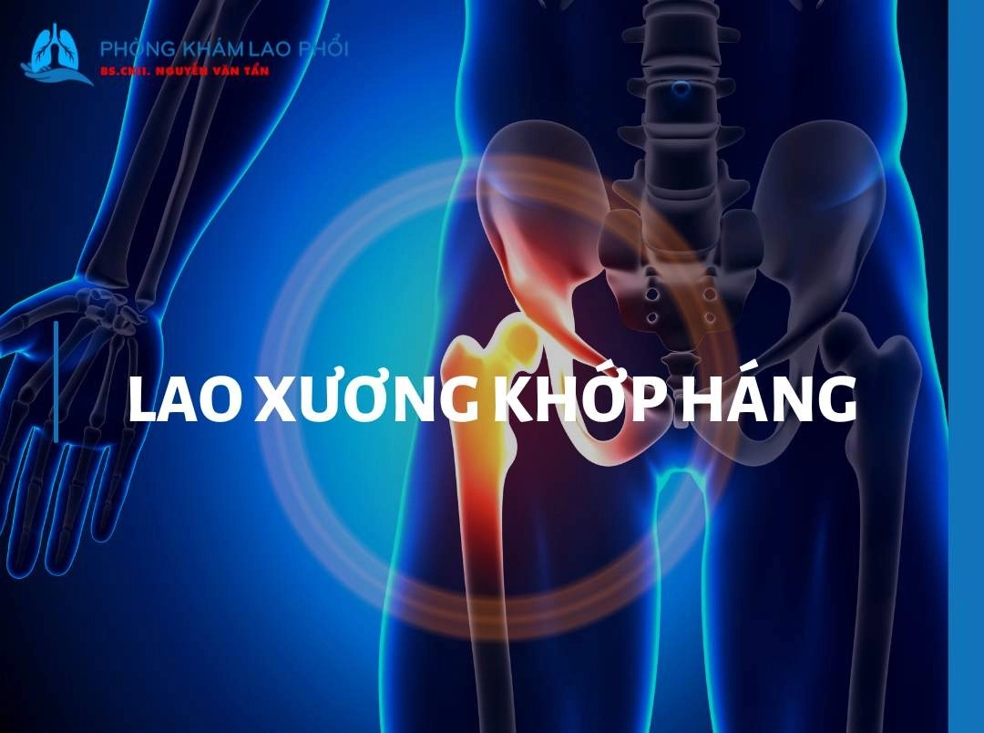 Lao xương khớp háng là gì? Triệu chứng và cách phòng ngừa