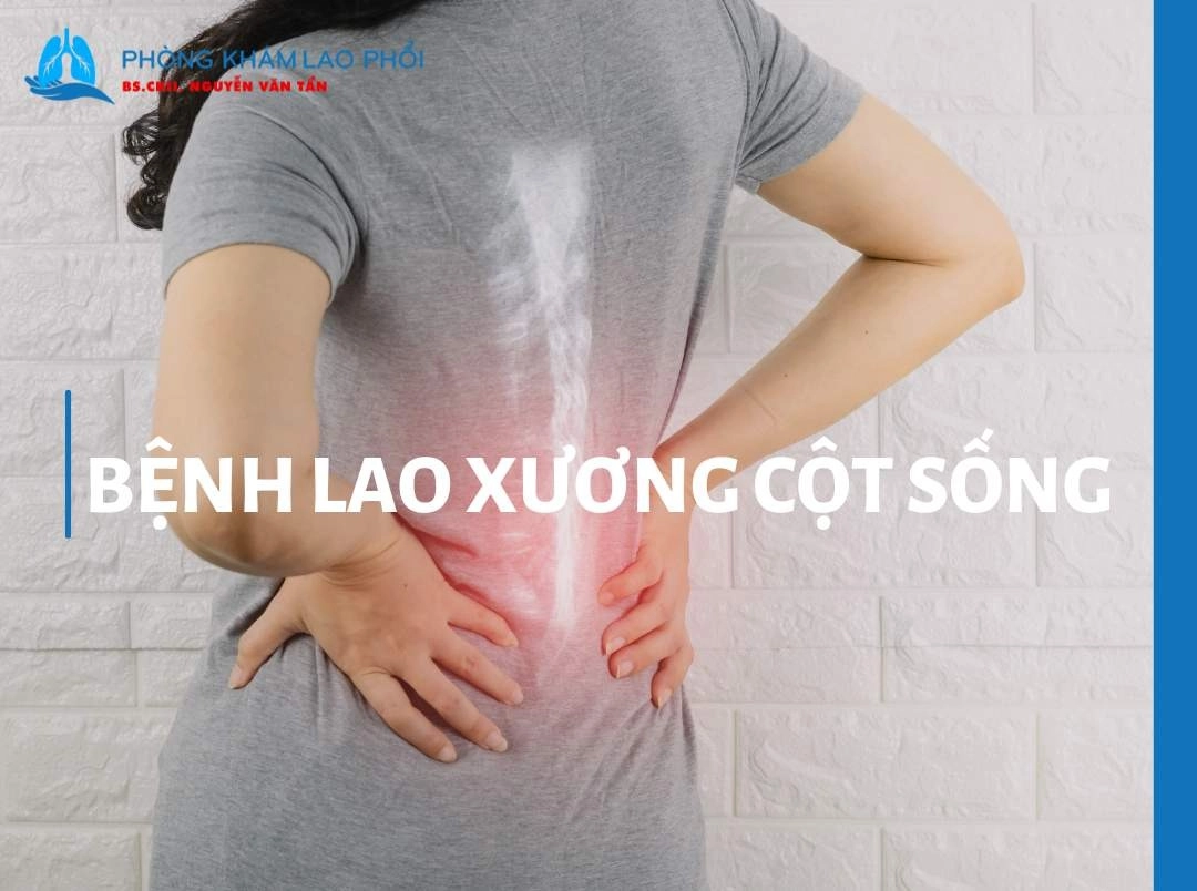 Bệnh lao xương cột sống - Nguyên nhân, triệu chứng và cách điều trị 