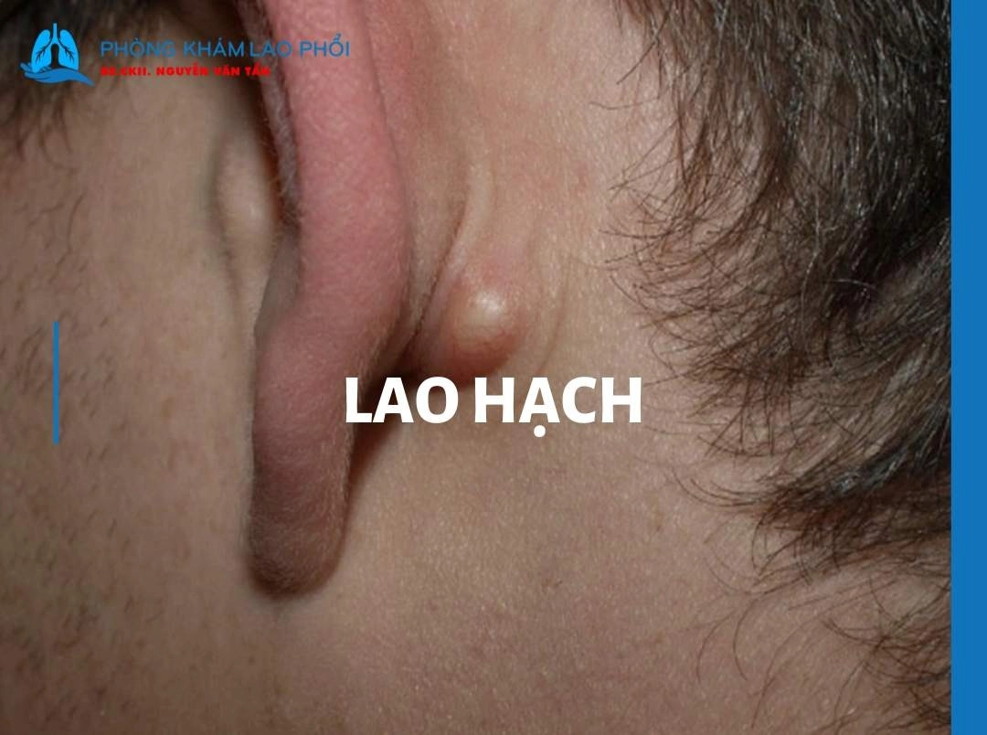 Lao hạch là gì? Nguyên nhân, triệu chứng, chẩn đoán và điều trị [2025]