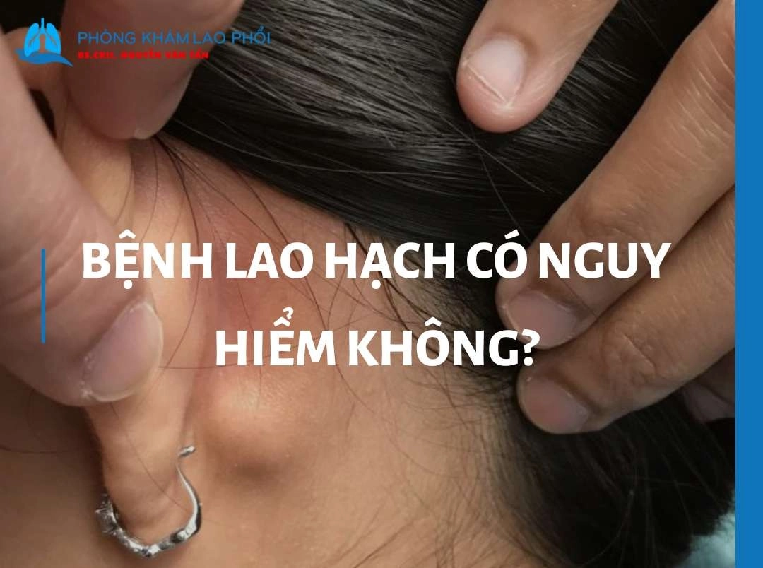 Bệnh lao hạch có nguy hiểm không? Biến chứng và cách phòng ngừa