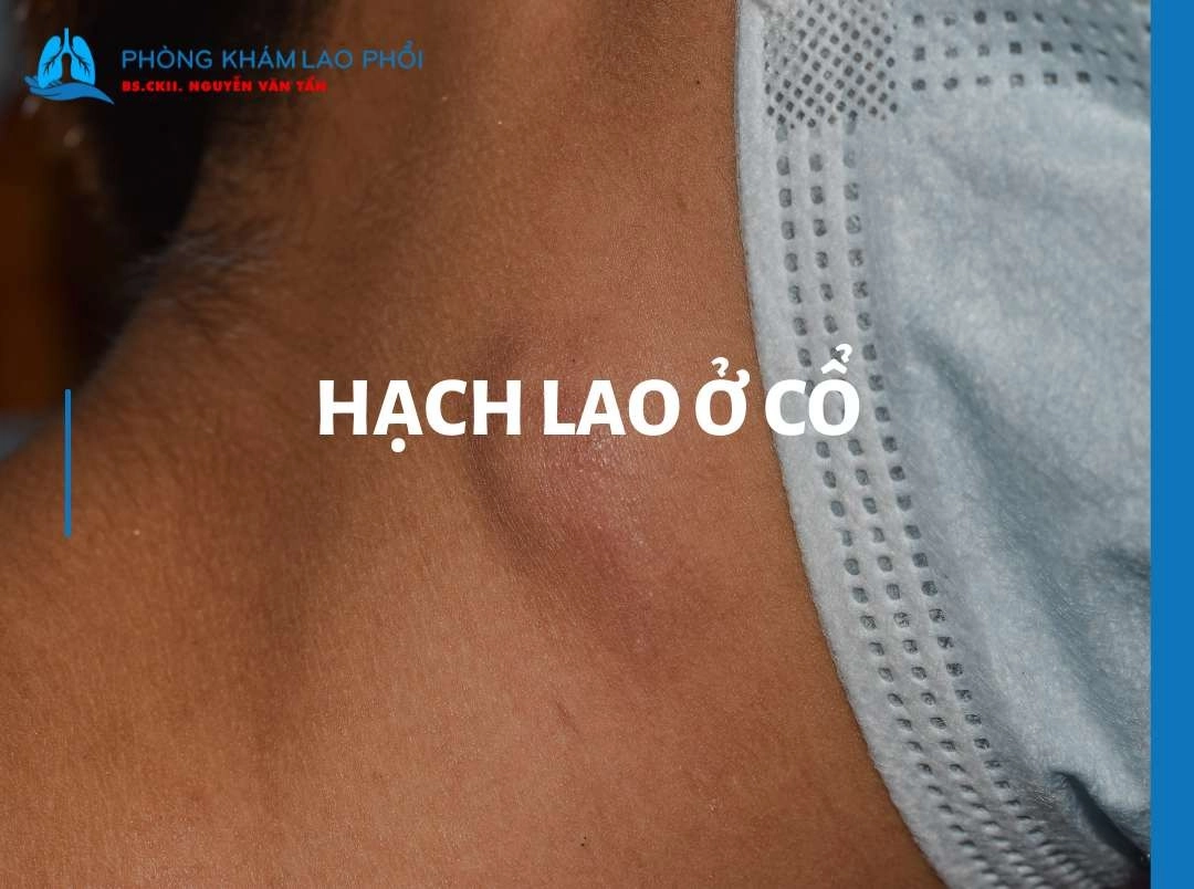 Lao hạch ở cổ có nguy hiểm không? Dấu hiệu nhận biết và cách điều trị