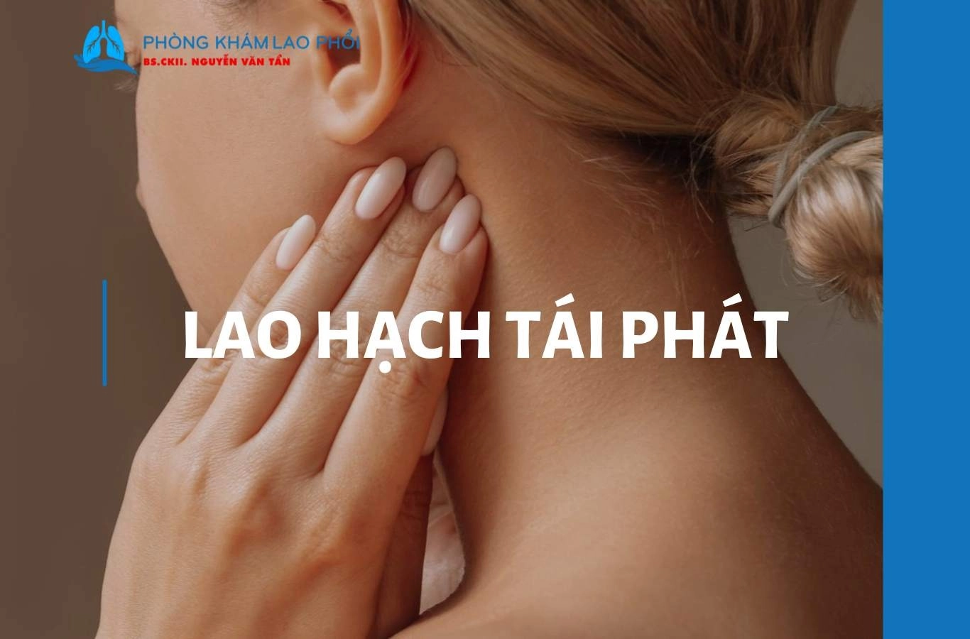 Bệnh lao hạch tái phát có tái phát không? Giải đáp từ chuyên gia