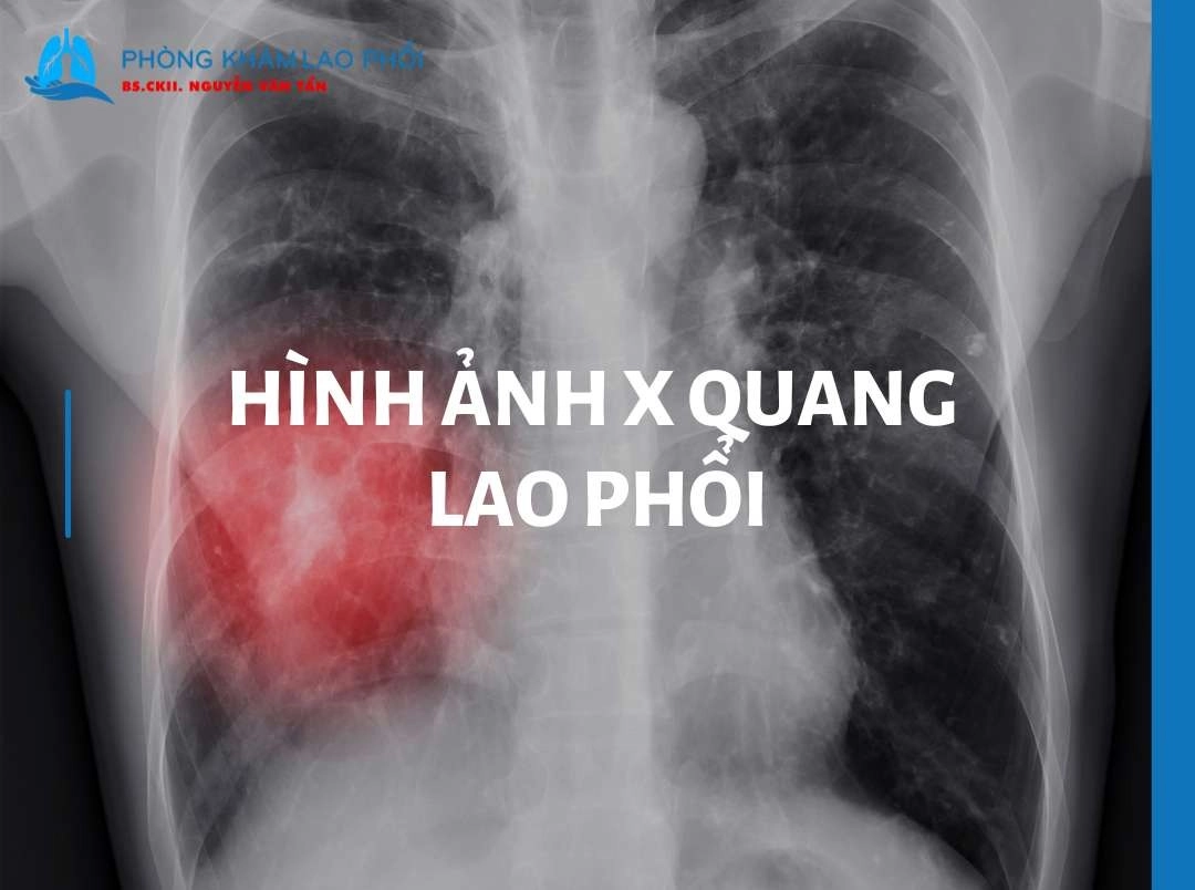 Hình ảnh x quang lao phổi: Hướng dẫn phân tích và nhận biết