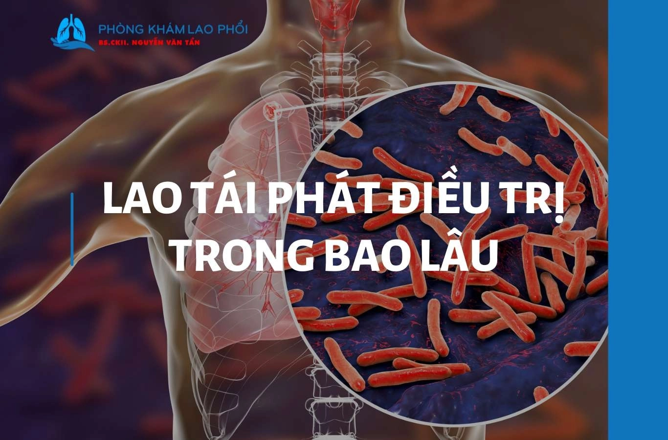 Lao tái phát điều trị trong bao lâu? Thời gian và phương pháp điều trị