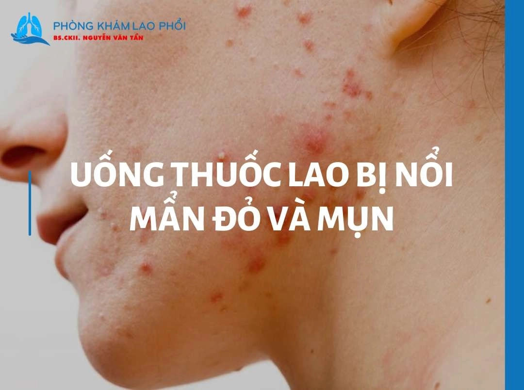 Uống thuốc lao bị nổi mẩn đỏ và mụn? Hướng dẫn xử trí đúng cách