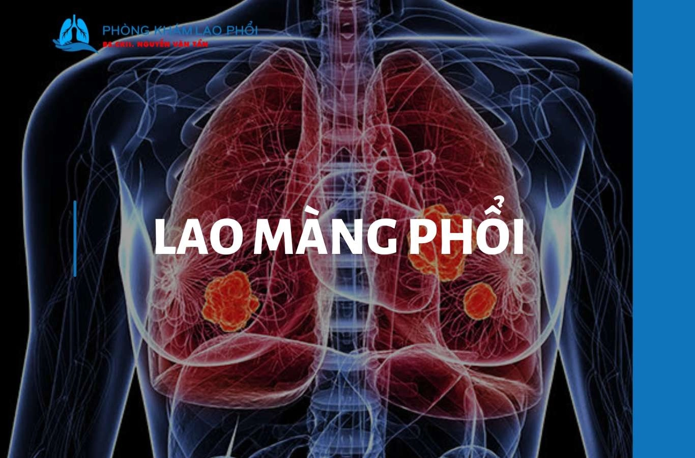 Lao màng phổi: Dấu hiệu, nguyên nhân và cách điều trị hiệu quả