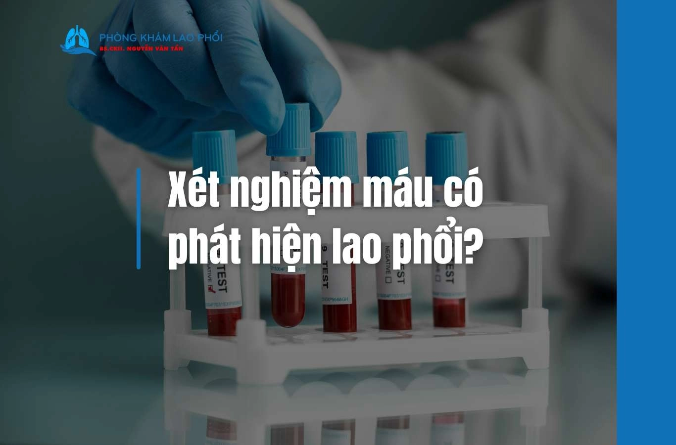 Xét nghiệm máu có phát hiện lao phổi không? Ưu điểm, hạn chế và lưu ý