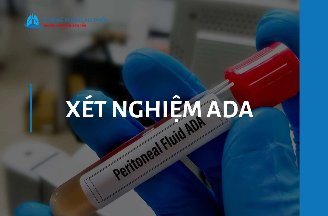 Xét nghiệm Adenosine Deaminase (ADA) là gì? Ý nghĩa và vai trò