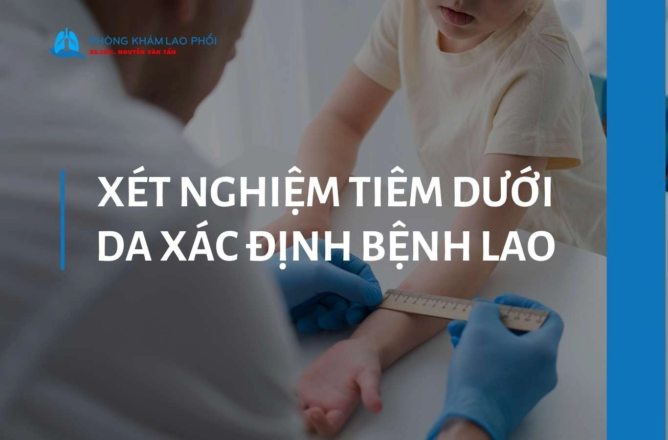 Xét nghiệm tiêm dưới da xác định bệnh lao (Mantoux) là gì?
