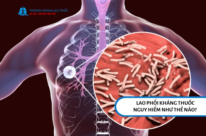 Bệnh lao kháng thuốc sống được bao lâu? Yếu tố giúp kéo dài tuổi thọ