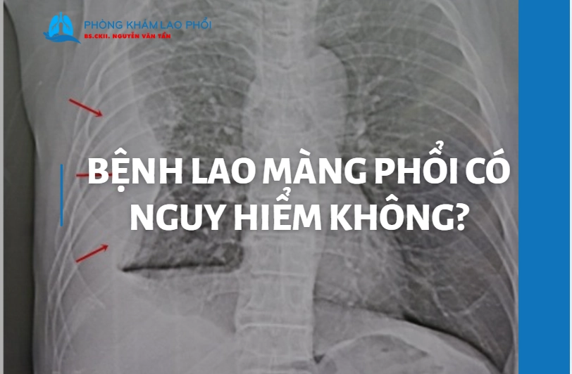Bệnh lao màng phổi có nguy hiểm không? Những rủi ro cần biết
