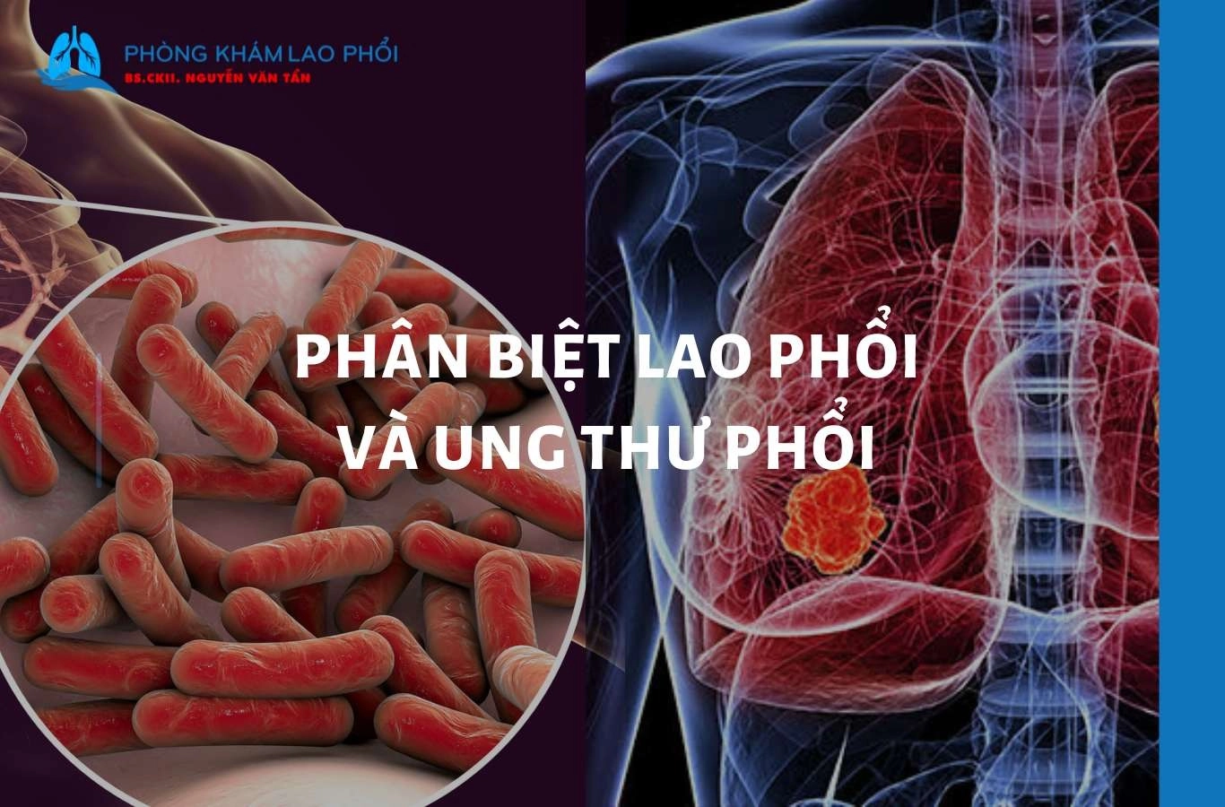 Cách phân biệt lao phổi và ung thư phổi? So sánh triệu chứng
