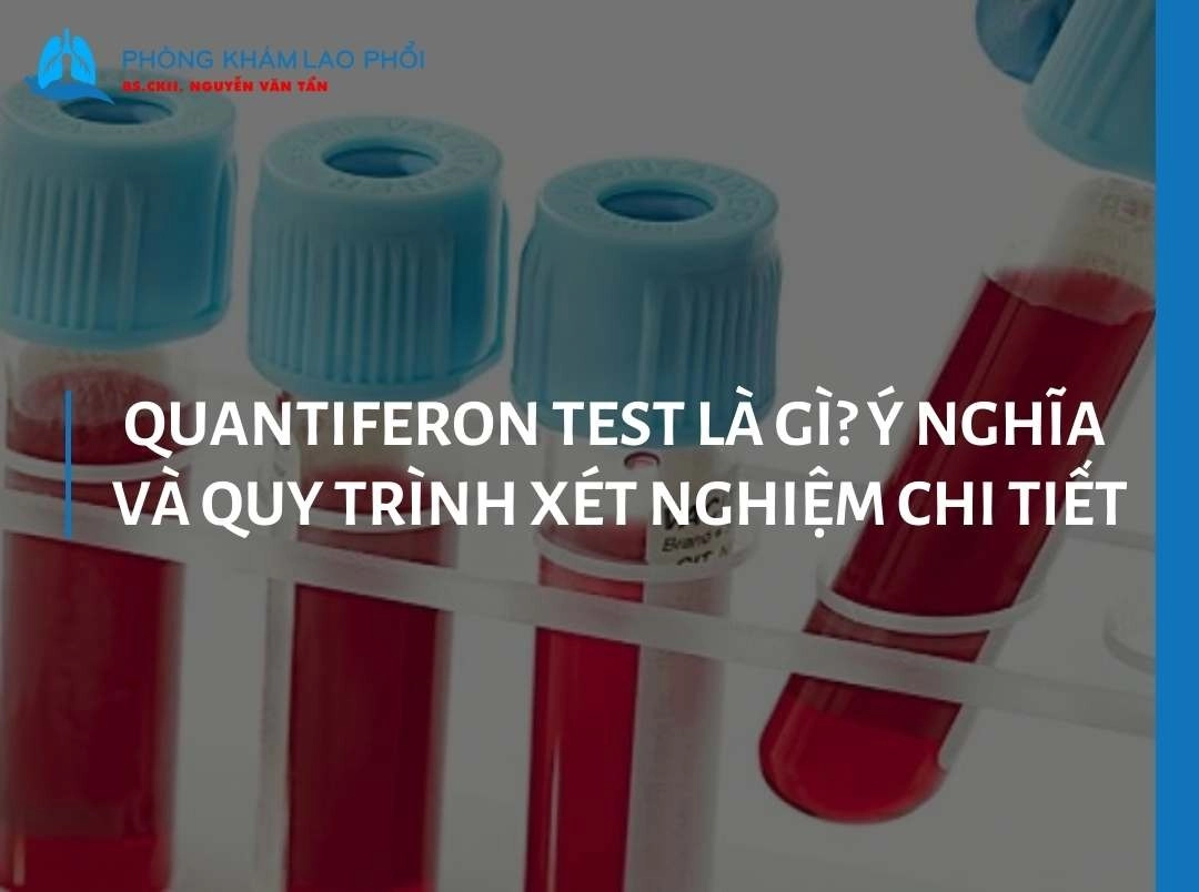 Quantiferon test là gì? Ý nghĩa và quy trình xét nghiệm chi tiết