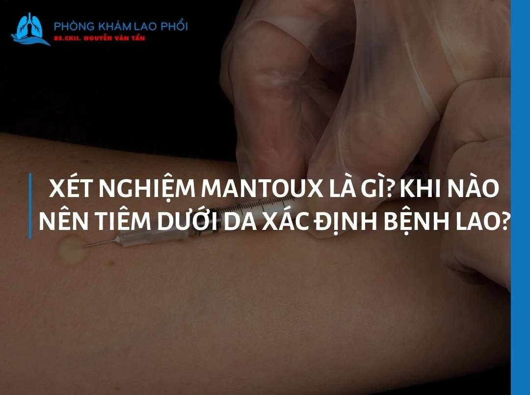 Xét nghiệm Mantoux là gì? Khi nào nên tiêm dưới da xác định bệnh lao?