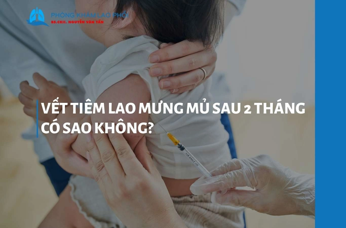 Vết tiêm lao mưng mủ sau 4 tháng có sao không? Bình thường hay nguy hiểm?