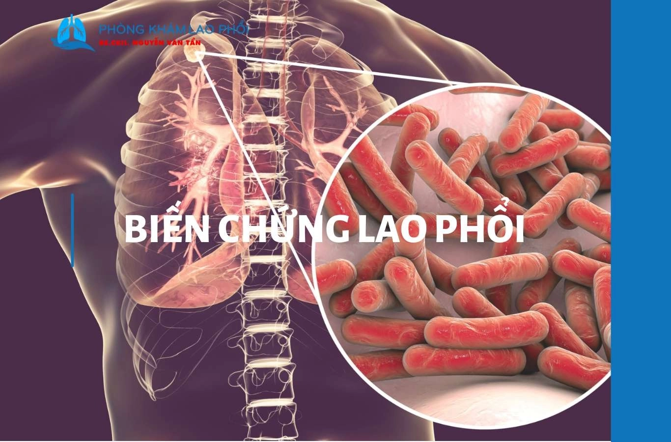 Top 12 biến chứng lao phổi thường gặp và dấu hiệu nguy hiểm 