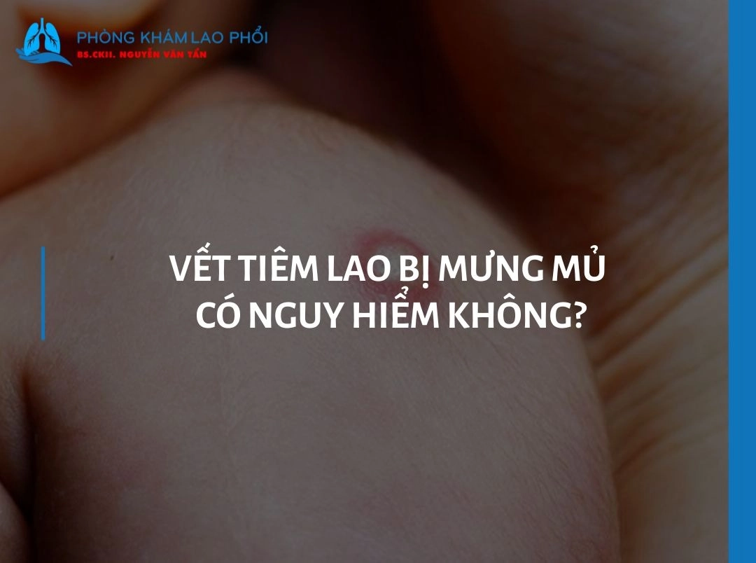 Vết tiêm lao bị mưng mủ có nguy hiểm không?