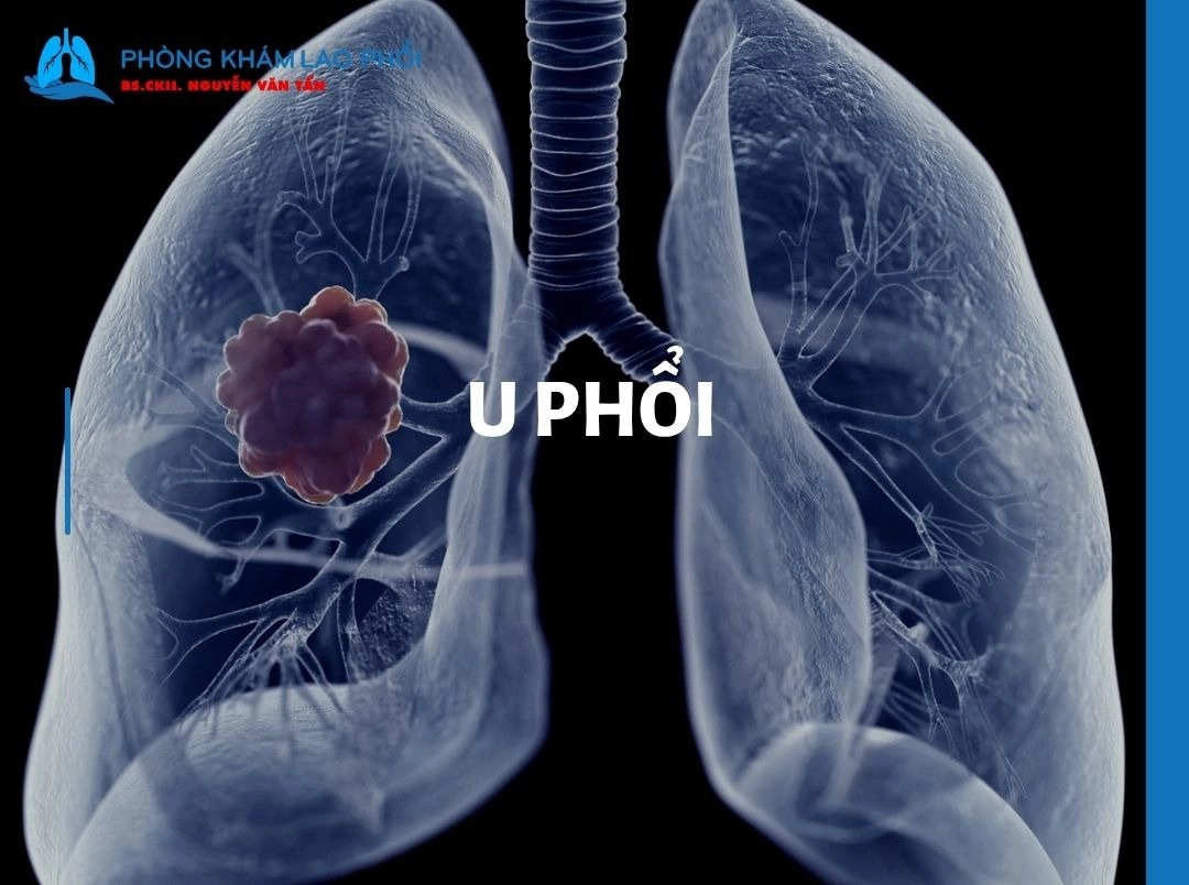 U phổi là gì? Có phải ung thư và có nguy hiểm không?
