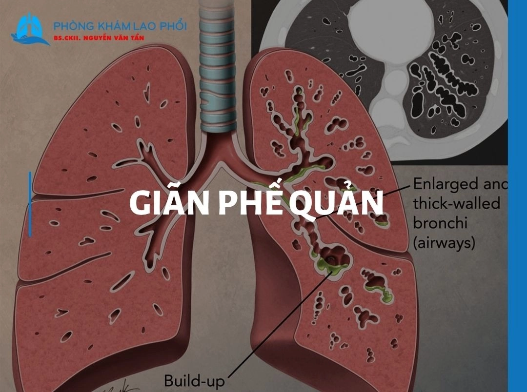 Bệnh giãn phế quản là gì? Dấu hiệu nhận biết và cách điều trị