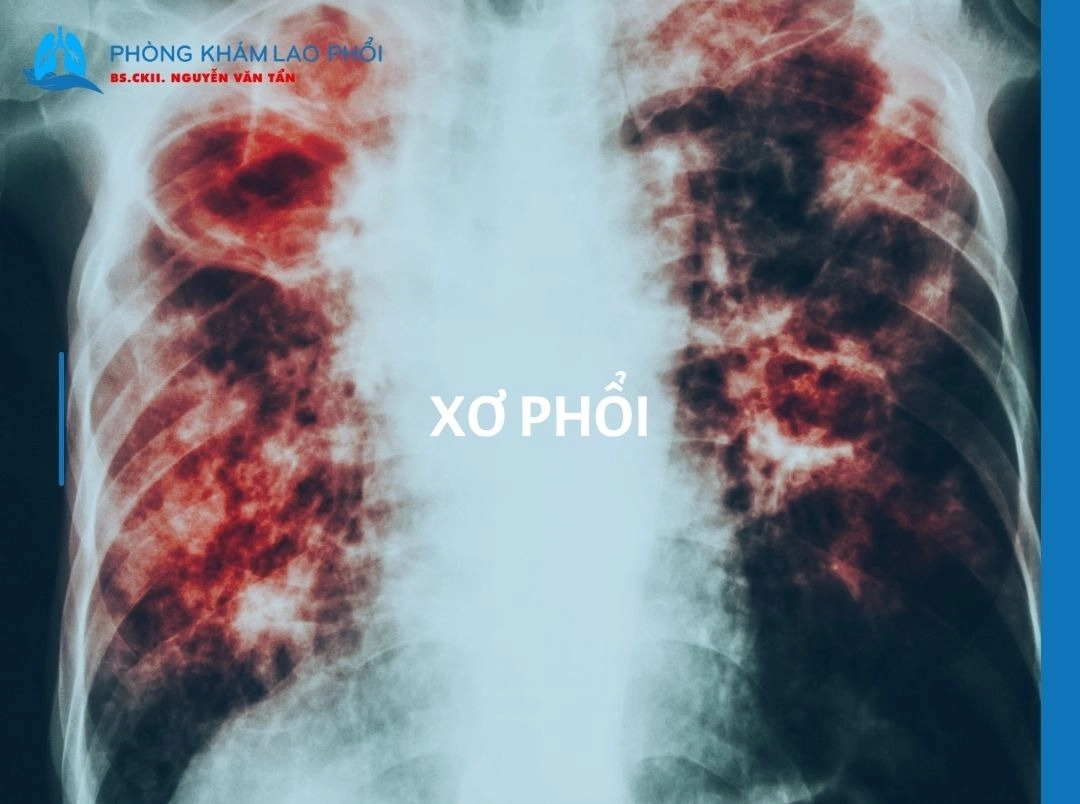 Bệnh xơ phổi là gì? Dấu hiệu, nguyên nhân, biến chứng và cách điều trị