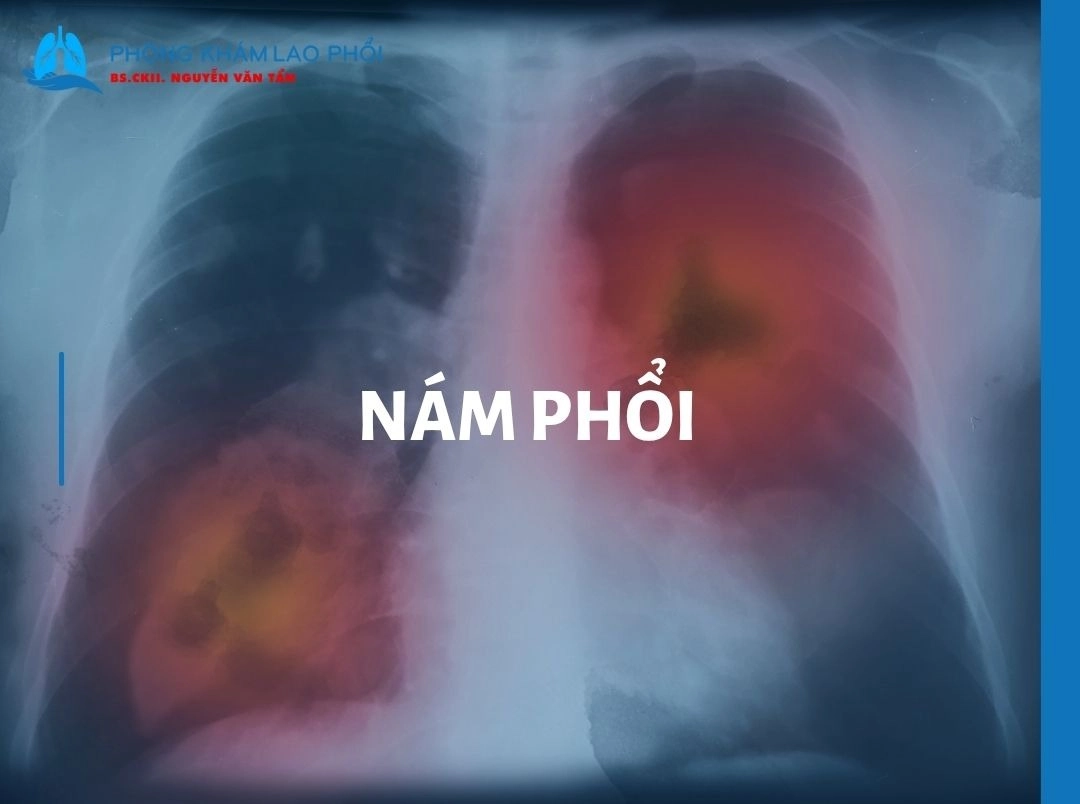 Nám phổi là gì? Nguyên nhân, triệu chứng, cách chẩn đoán và điều trị