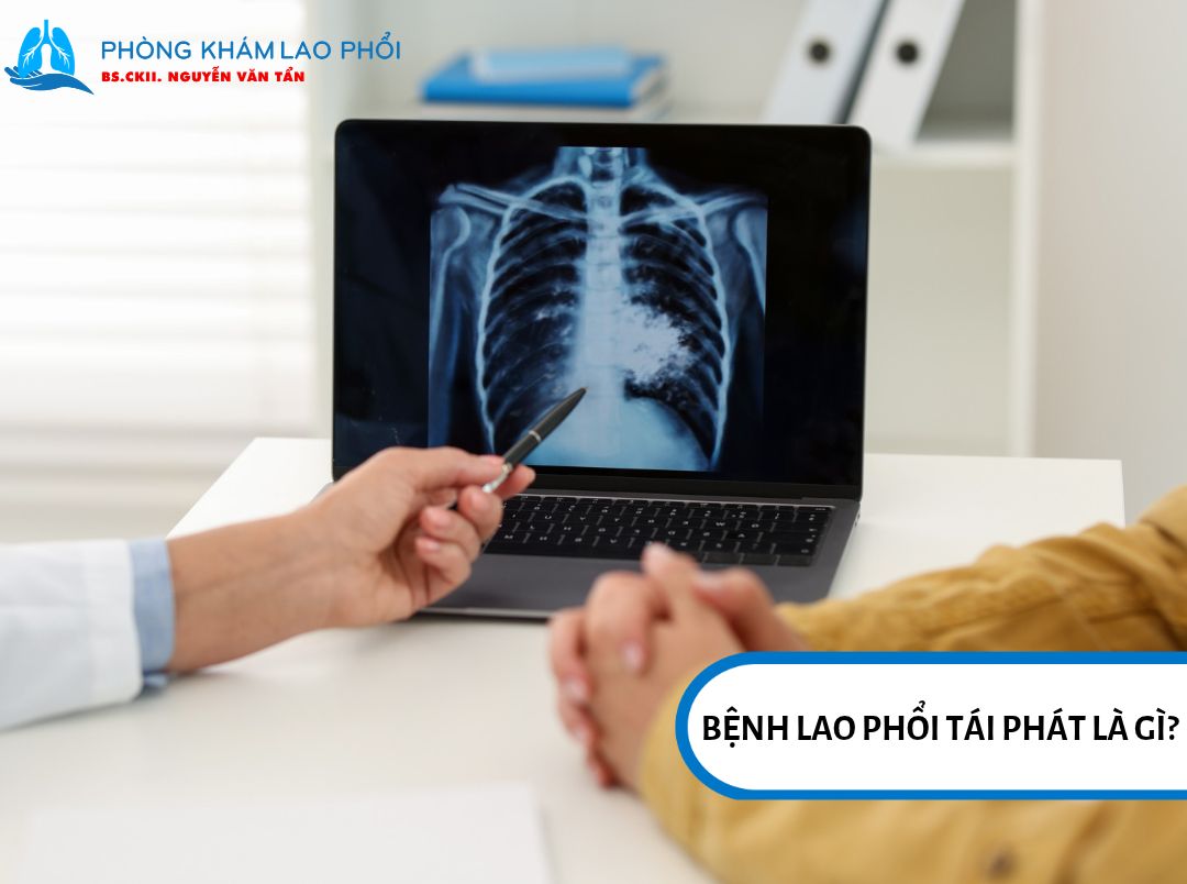 Lao phổi tái phát xuất hiện khi người bệnh được chẩn đoán mắc lao trở lại sau khi đã điều trị khỏi trước đó