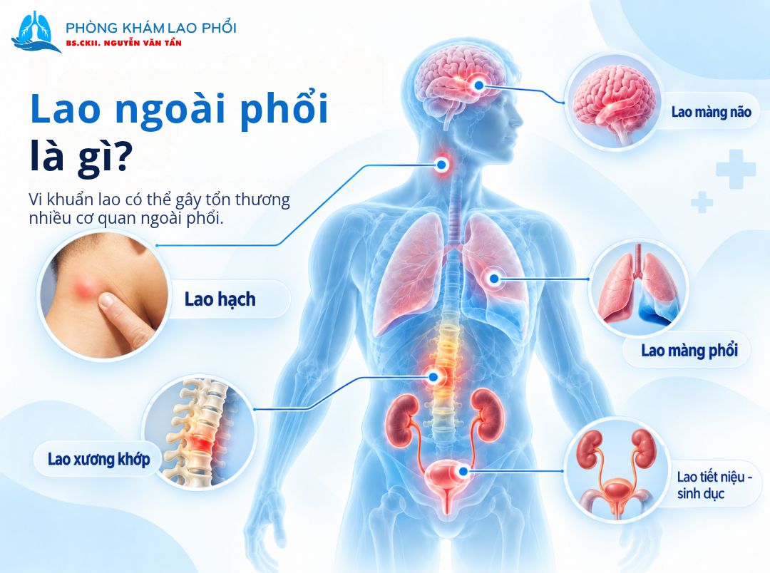 Có thể gặp lao hạch, lao màng não, lao màng phổi, lao xương khớp, lao tiết niệu - sinh dục