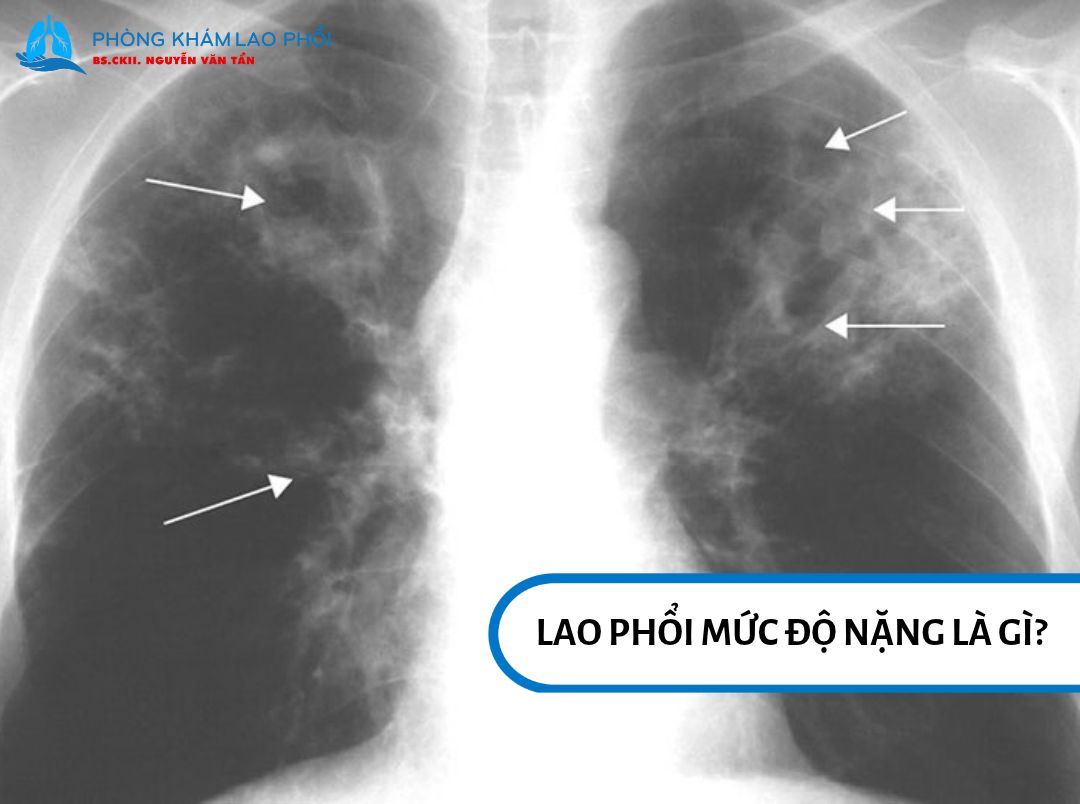Lao phổi giai đoạn nặng ảnh hưởng đến chức năng hô hấp và có thể đe dọa tính mạng