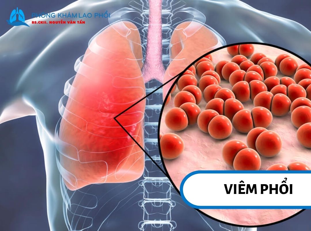  Hình ảnh phổi bị viêm do nhiễm trùng