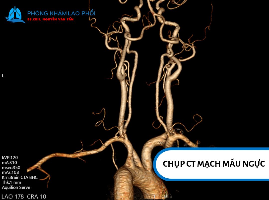 Chụp CT mạch máu ngực giúp phát hiện các bất thường trong hệ mạch lồng ngực
