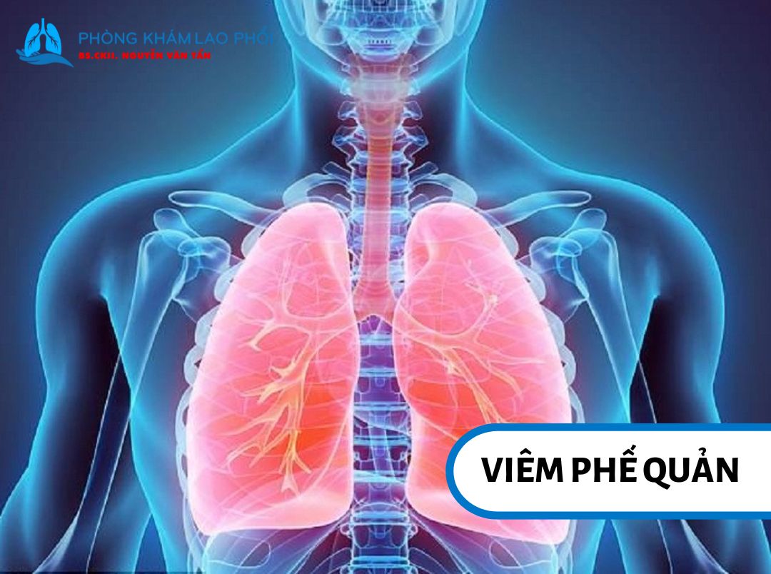 Niêm mạc phế quản bị viêm, sưng và tăng tiết chất nhầy