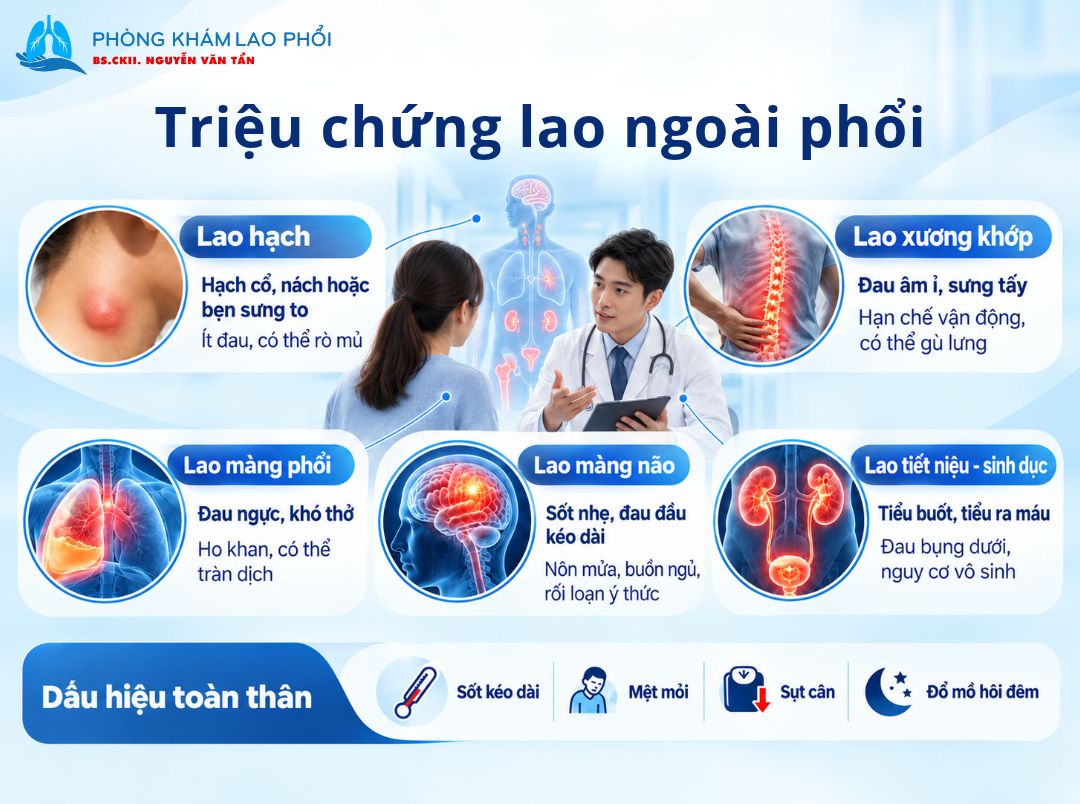 Triệu chứng của bệnh lao ngoài phổi phụ thuộc vào cơ quan bị vi khuẩn lao tấn công