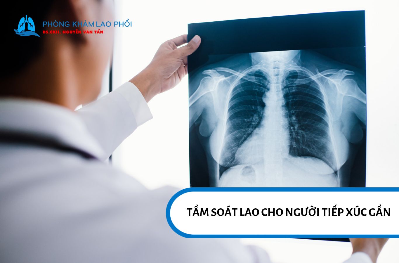 Tầm soát sớm giúp phát hiện nhiễm lao và can thiệp kịp thời sau khi tiếp xúc với nguồn lây