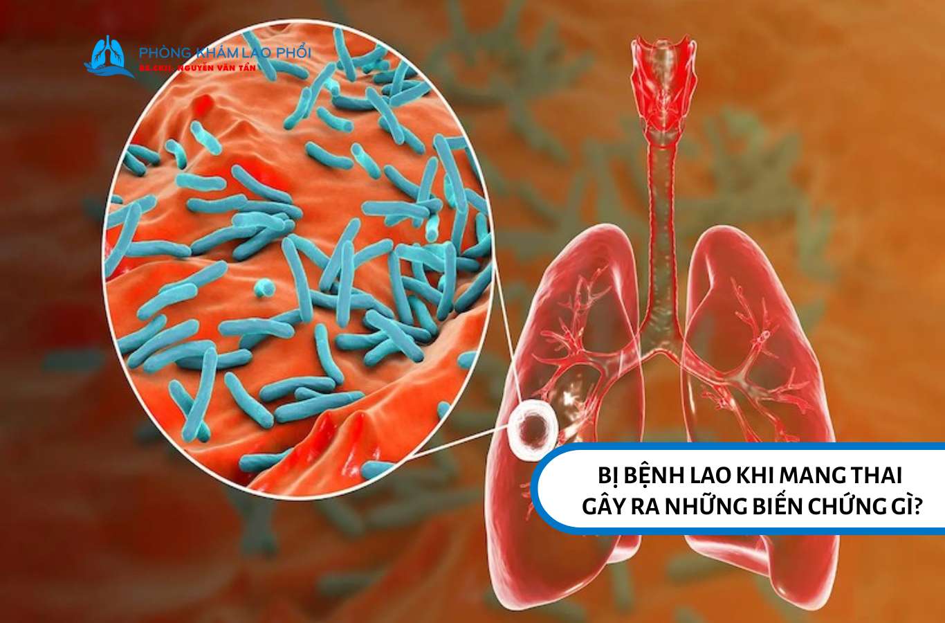Bị lao khi mang thai có thể gây sinh non, sảy thai, trẻ nhẹ cân và nguy cơ lây lao bẩm sinh cho thai nhi