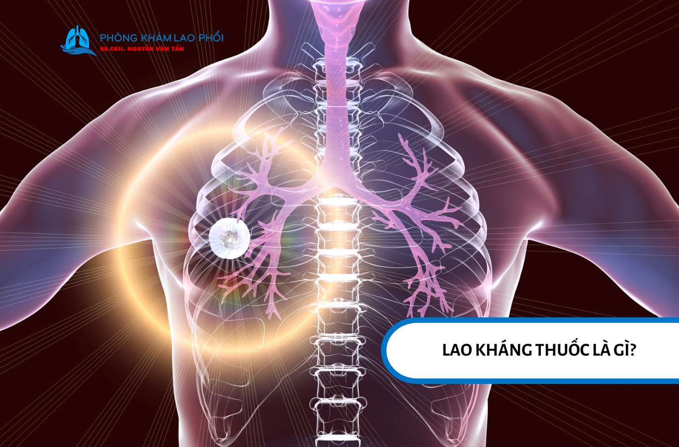 Lao kháng thuốc là là tình trạng vi khuẩn lao mất khả năng nhạy cảm thuốc điều trị 