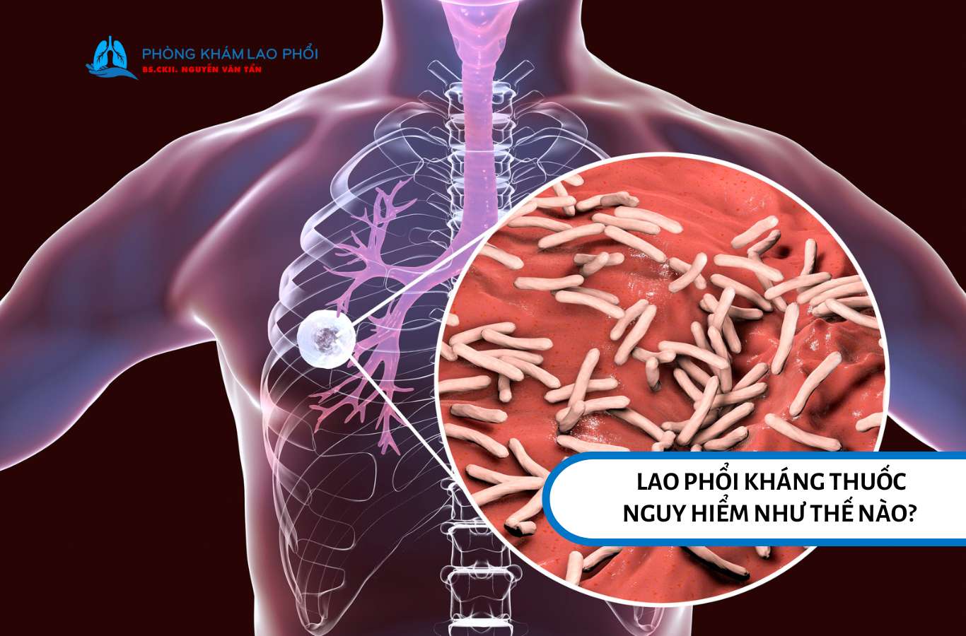 Lao kháng thuốc khiến việc điều trị trở nên phức tạp, kéo dài và tốn nhiều chi phí hơn