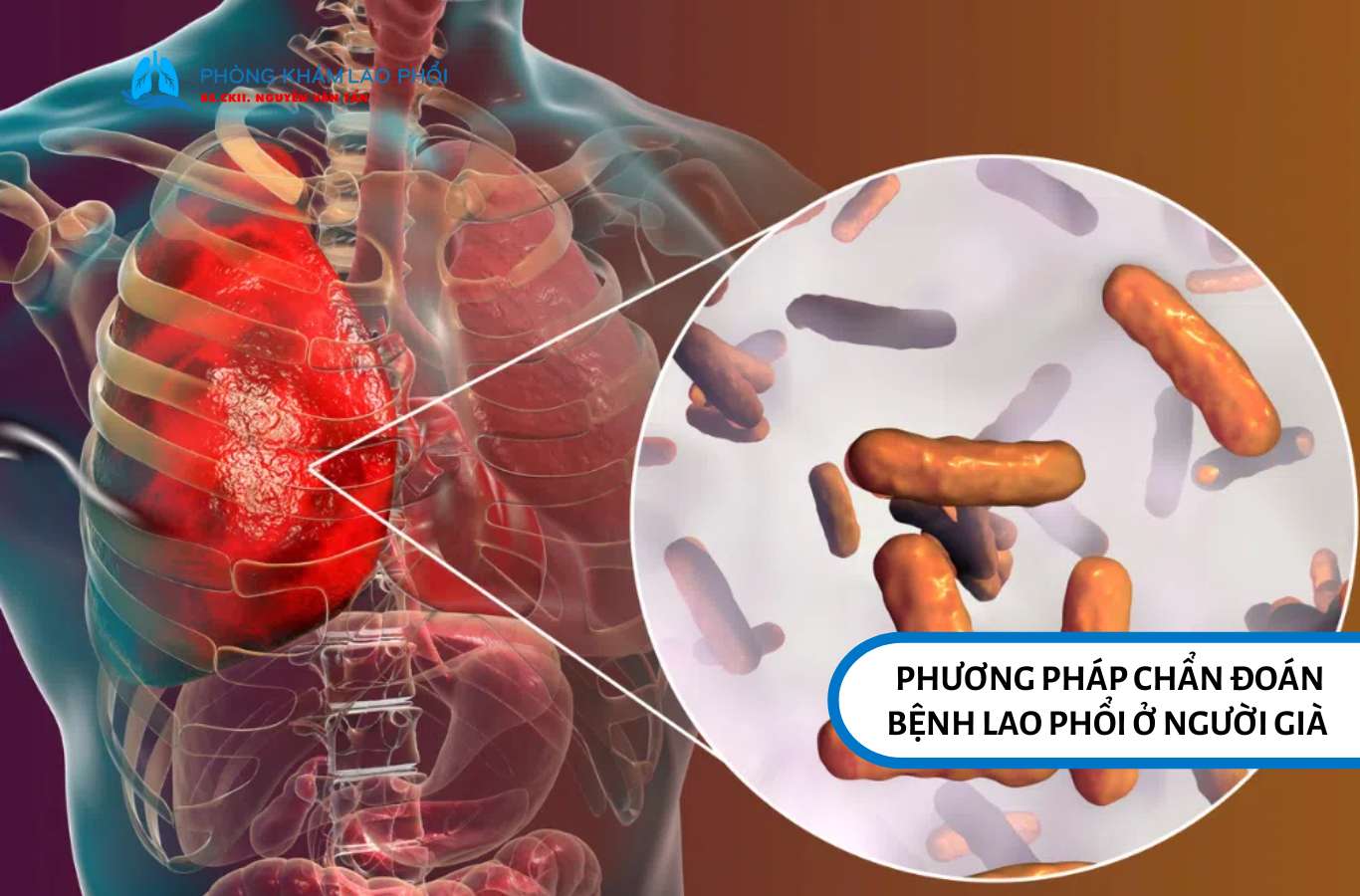 Phương pháp chẩn đoán bệnh lao phổi ở người già 