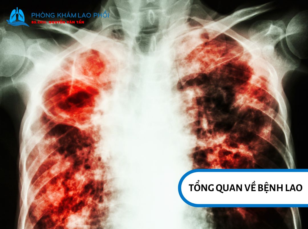 Bệnh lao do vi khuẩn Mycobacterium tuberculosis gây ra