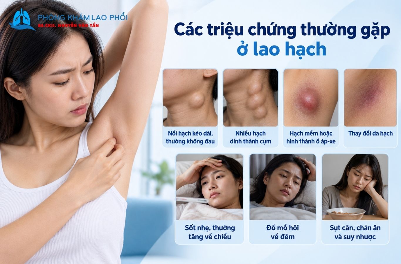 Lao hạch thường gây nổi hạch kéo dài, đặc biệt ở vùng cổ