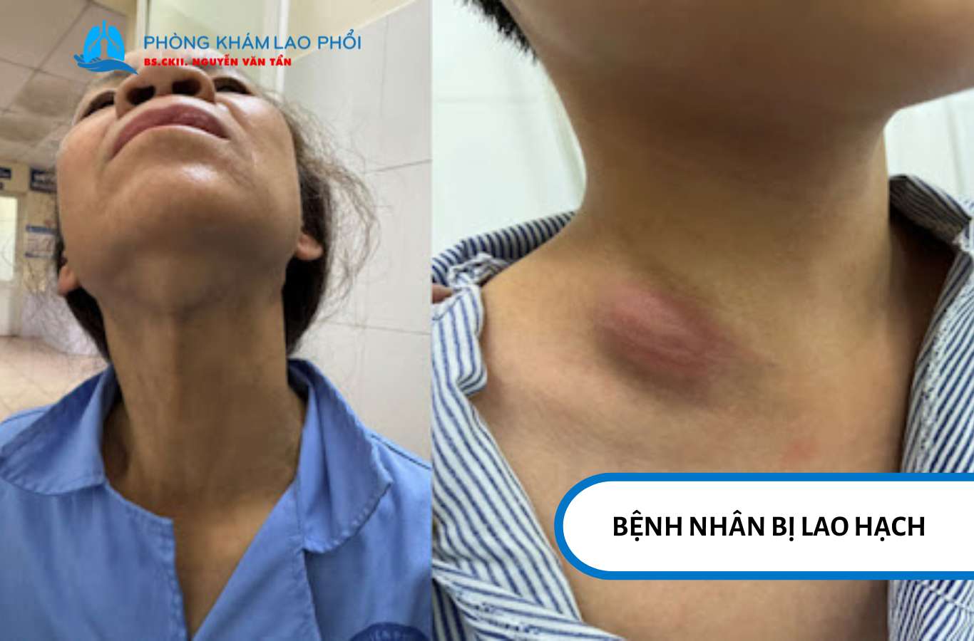 Lao hạch có lây không? Câu trả lời là không, nếu chỉ mắc lao hạch đơn thuần