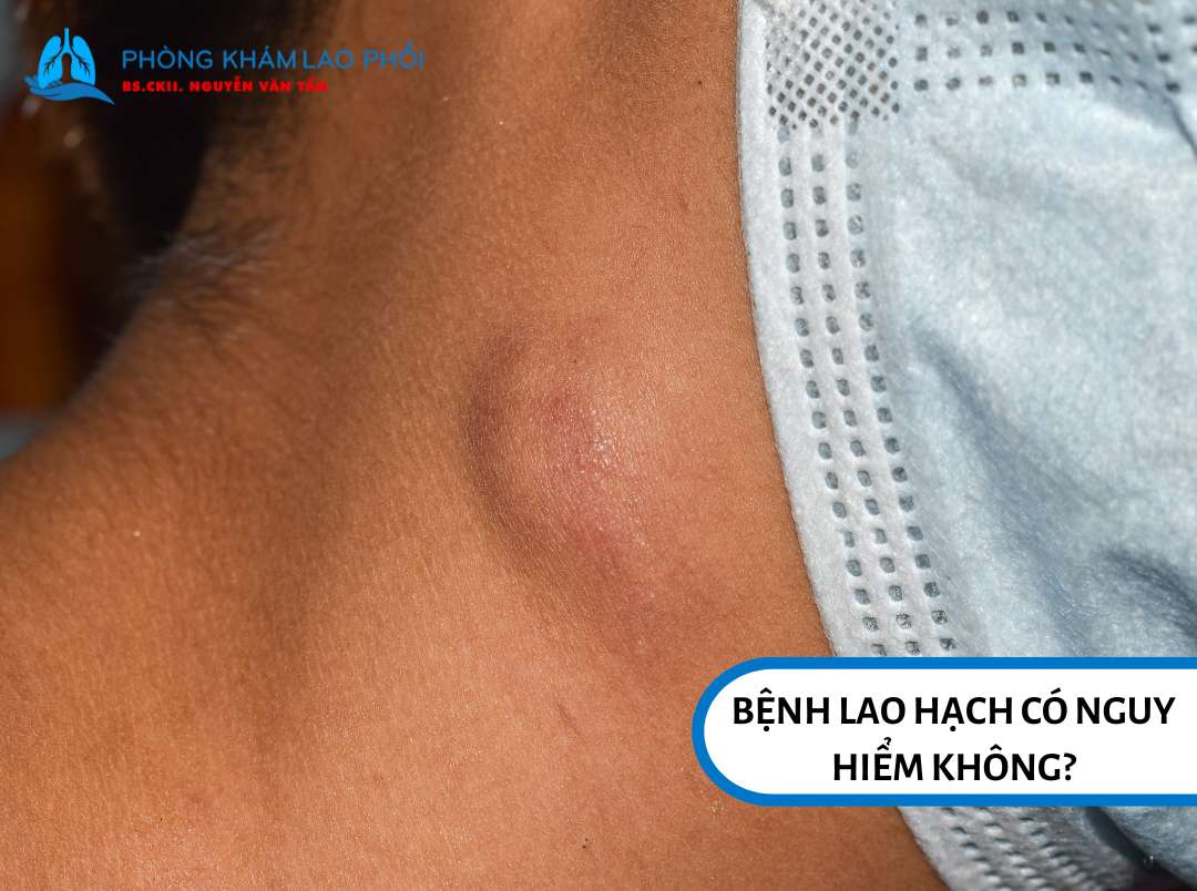 Bệnh lao phổi là căn bệnh nguy hiểm nếu không được phát hiện sớm và điều trị kịp thời